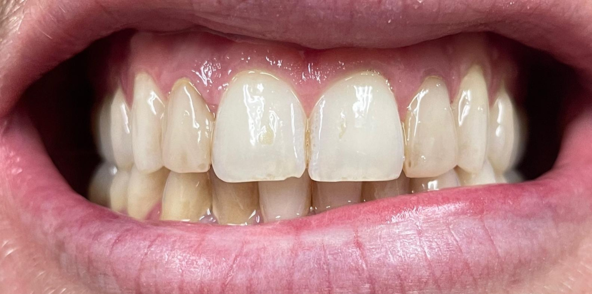 Before porcelain veneers - South Jersey Dental Studio