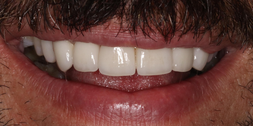After smile makeover - South Jersey Dental Studio