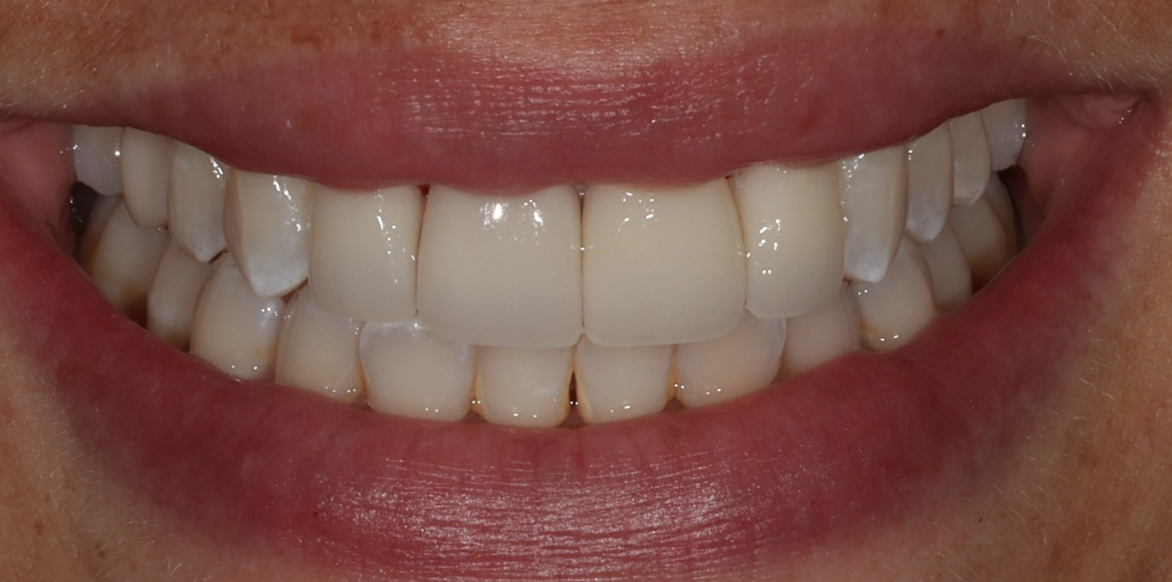 After Invisalign treatment - South Jersey Dental Studio