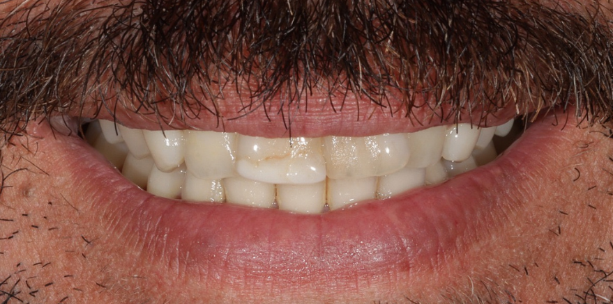 Before smile makeover - South Jersey Dental Studio