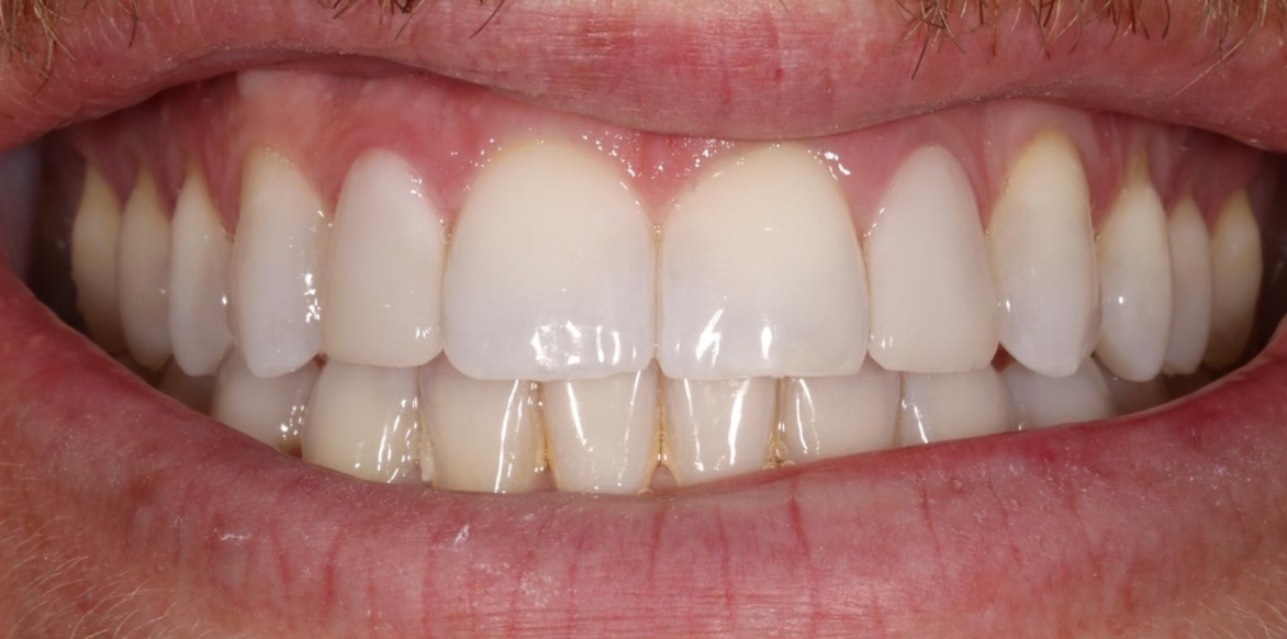 After porcelain veneers - South Jersey Dental Studio