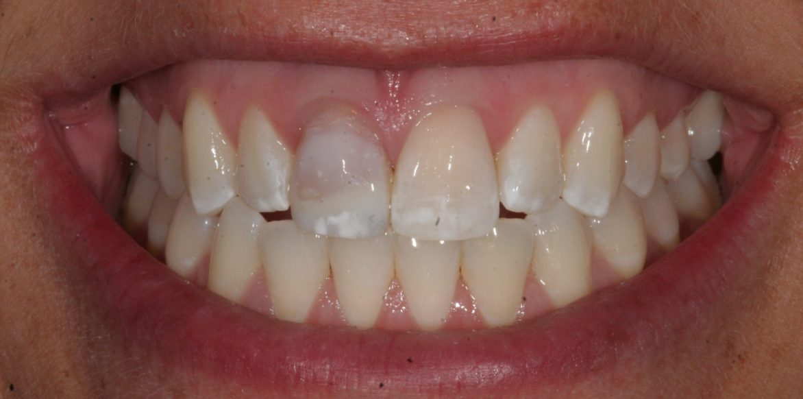 Before Invisalign treatment - South Jersey Dental Studio